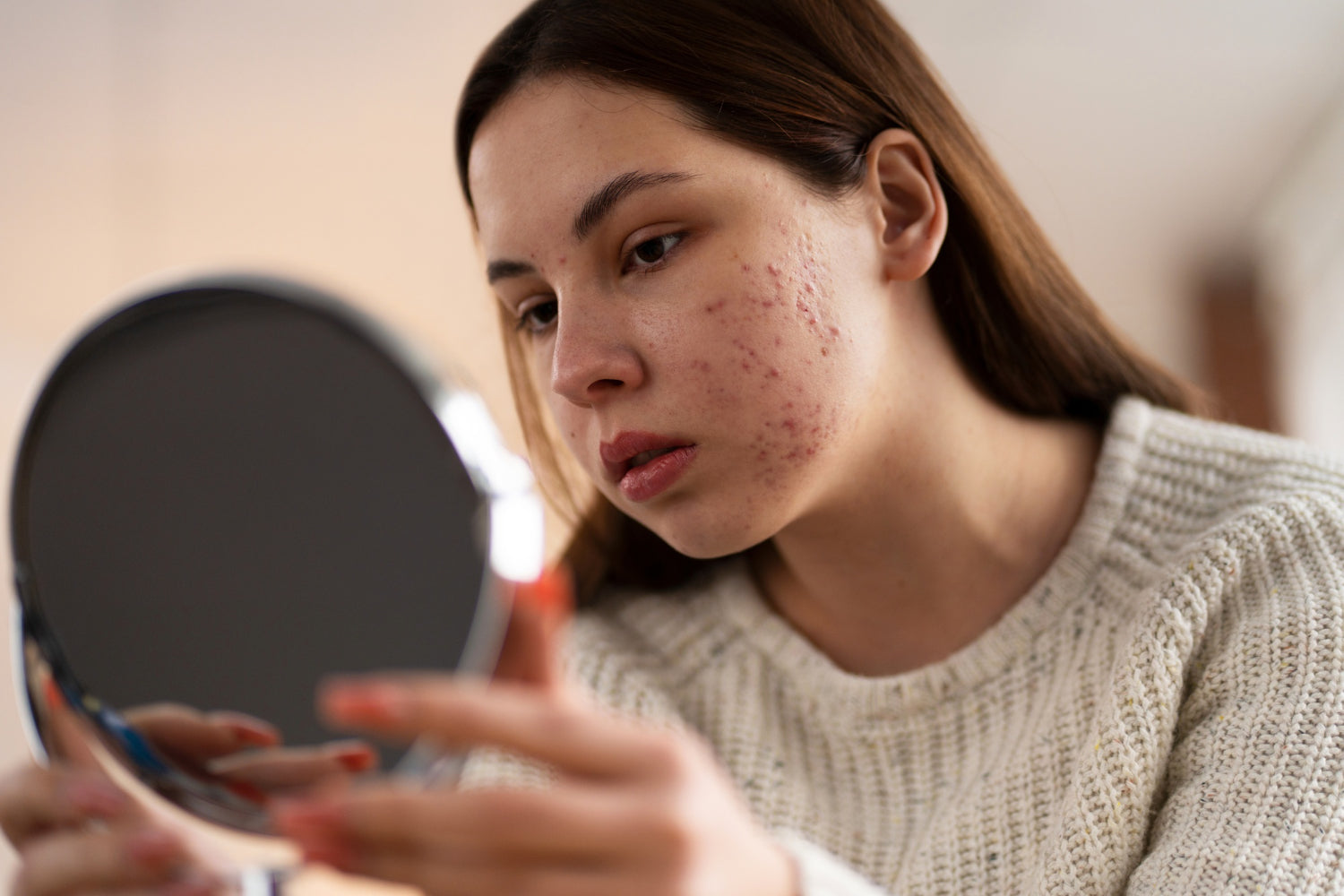 How to Treat Hyperpigmentation After Acne?