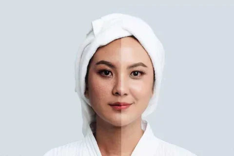 Does Sunscreen Help Hyperpigmentation And Dark Spots?