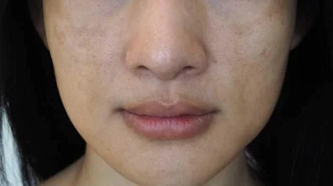 MELASMA AND HORMONES: HOW ARE THEY RELATED?